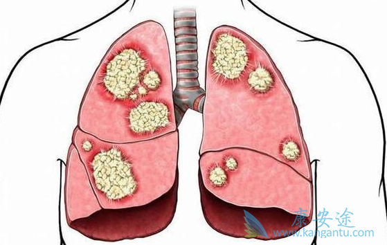 奥美替尼 奥美替尼