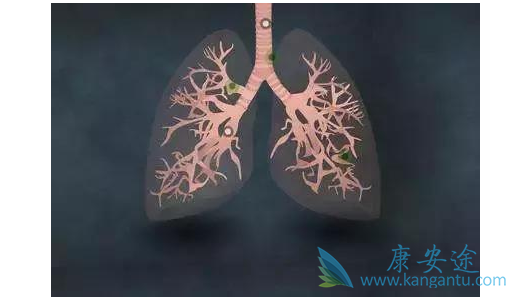 肺癌晚期能治好吗 肺癌晚期能治好吗