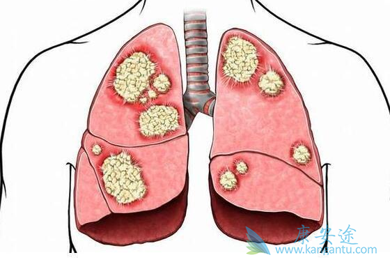 肺癌晚期能治好吗 肺癌晚期能治好吗