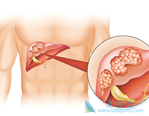 原发性肝癌 原发性肝癌