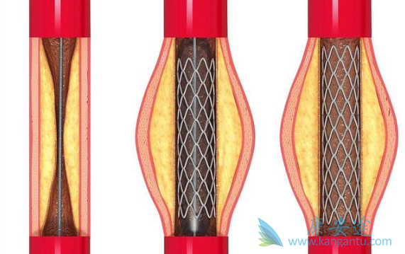 心脏支架手术 心脏支架手术