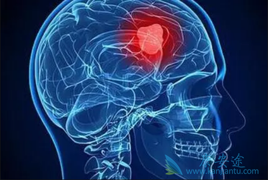 脑肿瘤 脑肿瘤