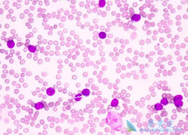 淋巴癌症状 淋巴癌症状