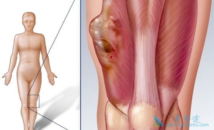 脂肪肉瘤 脂肪肉瘤