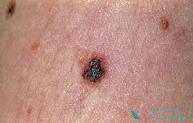 恶性黑色素瘤 恶性黑色素瘤