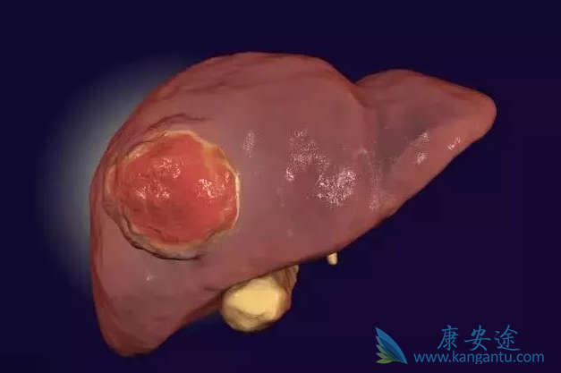 肝癌晚期能治好吗 肝癌晚期能治好吗