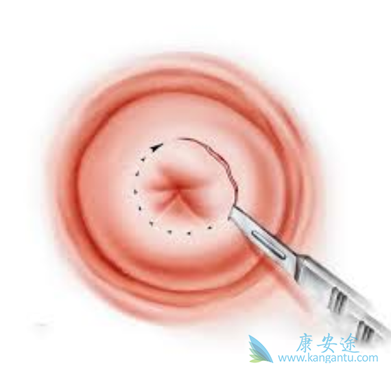 宫颈癌的原因 宫颈癌的原因