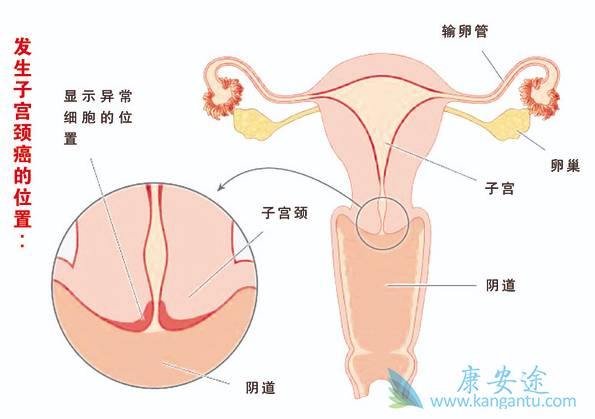 宫颈癌的治疗 宫颈癌的治疗
