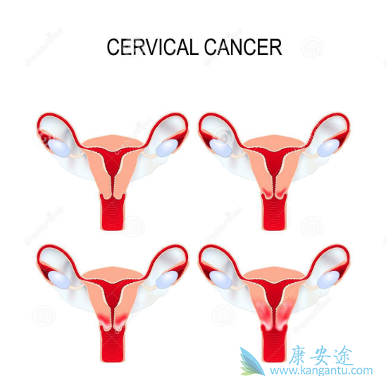 宫颈癌晚期能活多久 宫颈癌晚期能活多久