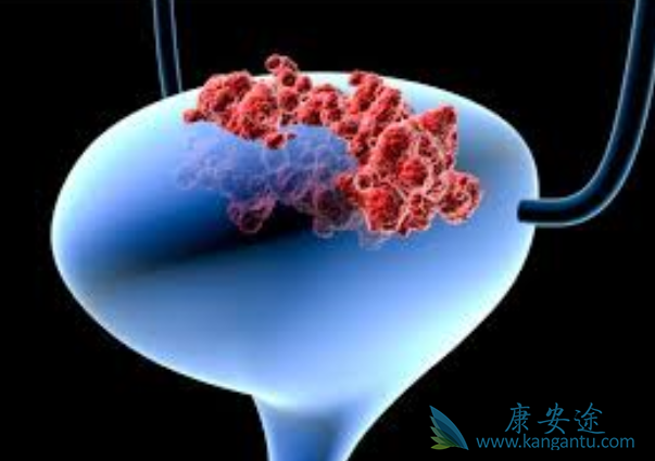 膀胱癌症状 膀胱癌症状