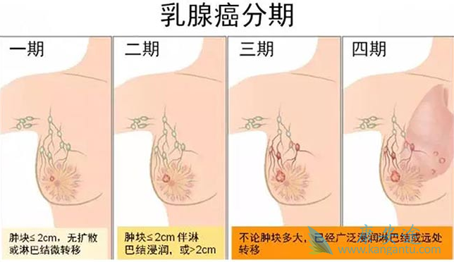 乳腺癌分期 乳腺癌分期