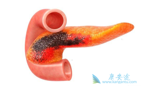 胰腺癌晚期能活多久 胰腺癌晚期能活多久