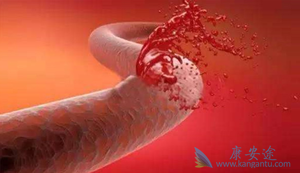 胃出血怎么办 胃出血怎么办