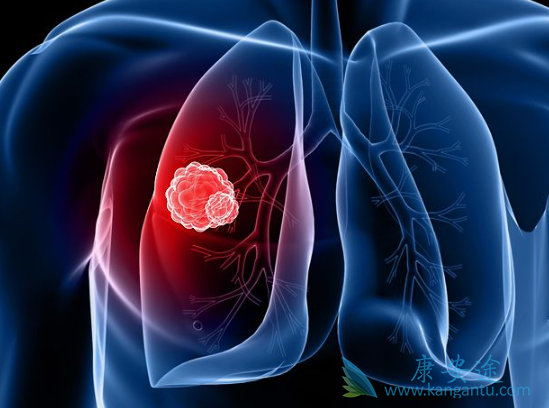 肺癌晚期 肺癌晚期