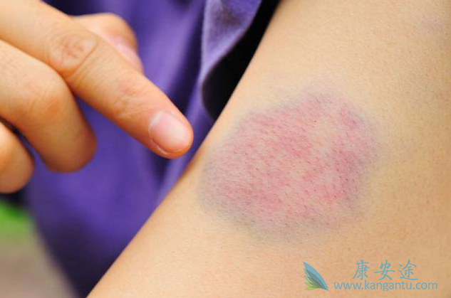 血癌的症状 血癌的症状