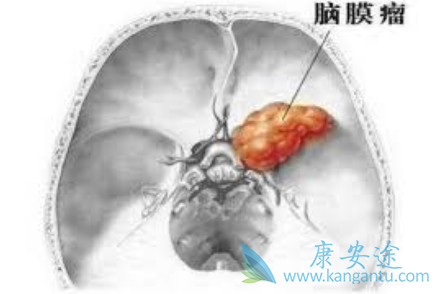 脑瘤手术 脑瘤手术