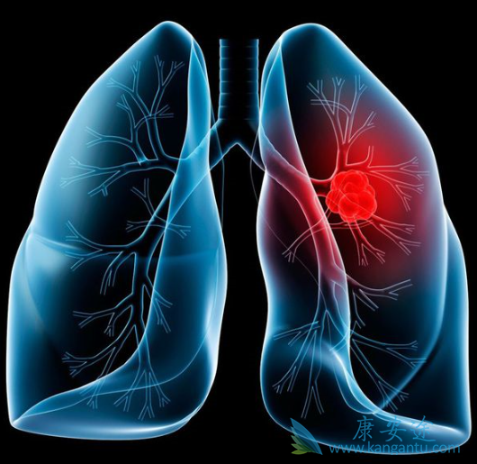 肺癌晚期会传染吗 肺癌晚期会传染吗
