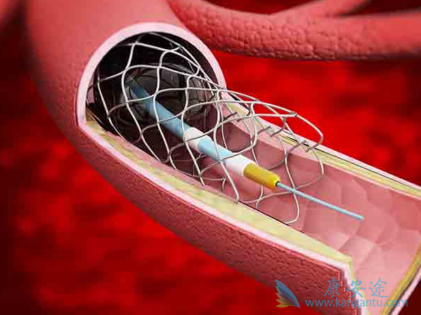 心脏支架 心脏支架