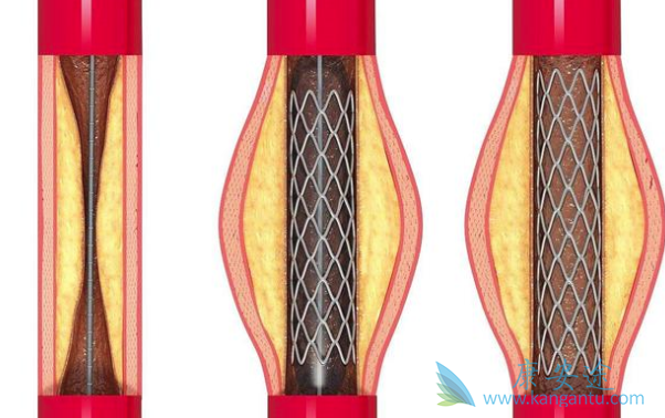 心脏支架 心脏支架