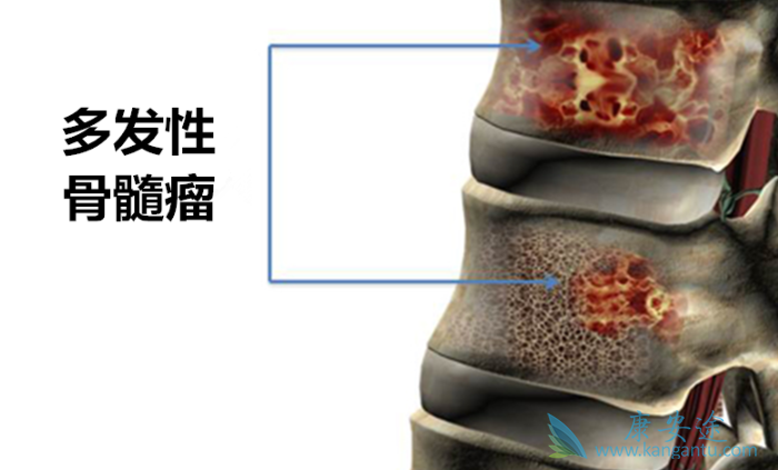 多发性骨髓瘤 多发性骨髓瘤