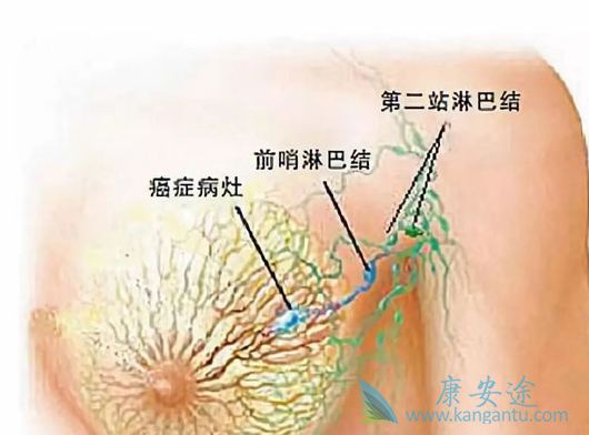 乳腺癌分期 乳腺癌分期