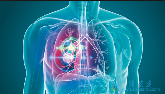 肺癌晚期 肺癌晚期