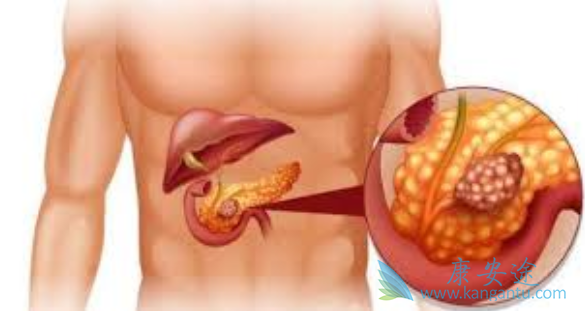 胰腺癌的症状 胰腺癌的症状
