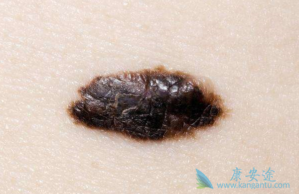 恶性黑素瘤 恶性黑素瘤