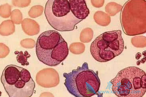 骨髓纤维化 骨髓纤维化