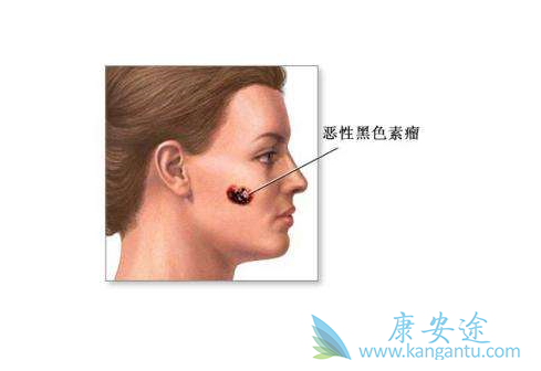 黑色素瘤 黑色素瘤