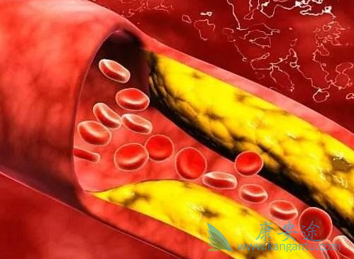 骨髓增生异常综合症 骨髓增生异常综合症