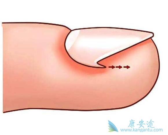 甲沟炎怎么办 甲沟炎怎么办