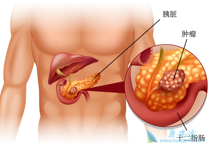 胰腺癌晚期能活多久 胰腺癌晚期能活多久
