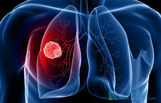 肺癌晚期 肺癌晚期