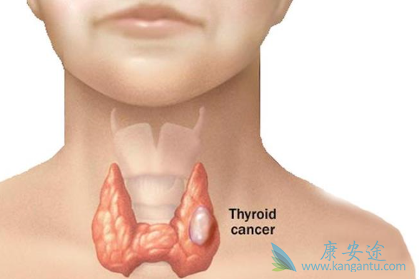 甲状腺癌症状 甲状腺癌症状