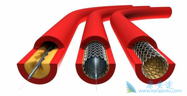 心脏支架 心脏支架