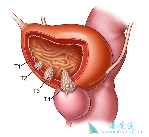膀胱癌治疗 膀胱癌治疗