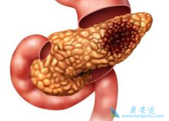 胰腺癌晚期能活多久 胰腺癌晚期能活多久