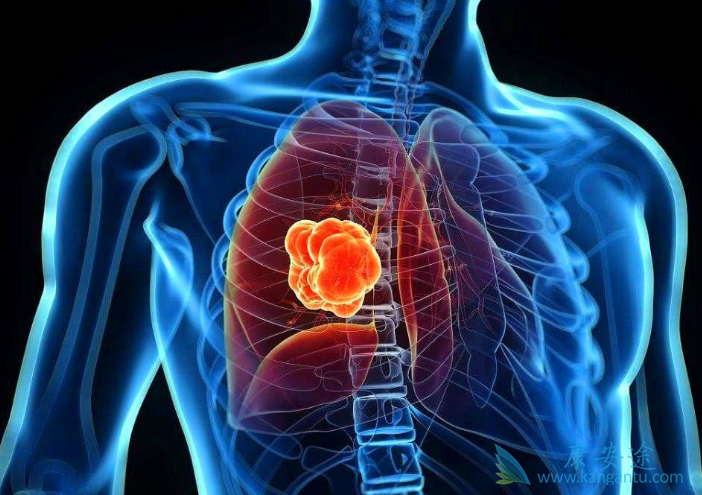 肺癌晚期 肺癌晚期
