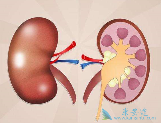 肾癌晚期 肾癌晚期