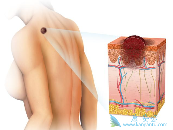 皮肤肿瘤 皮肤肿瘤