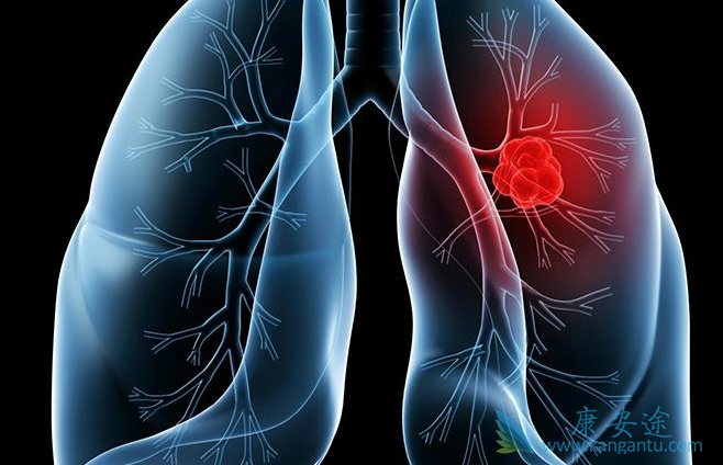 肺癌腺癌 肺癌腺癌