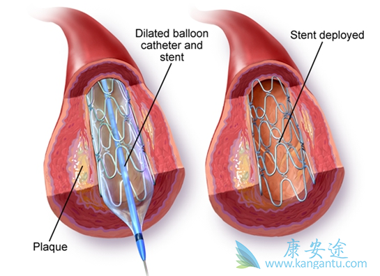 心脏支架手术后寿命 心脏支架手术后寿命