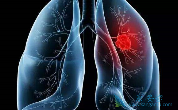 晚期肺癌 晚期肺癌