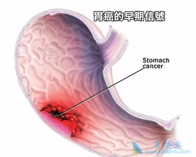胃癌晚期症状 胃癌晚期症状