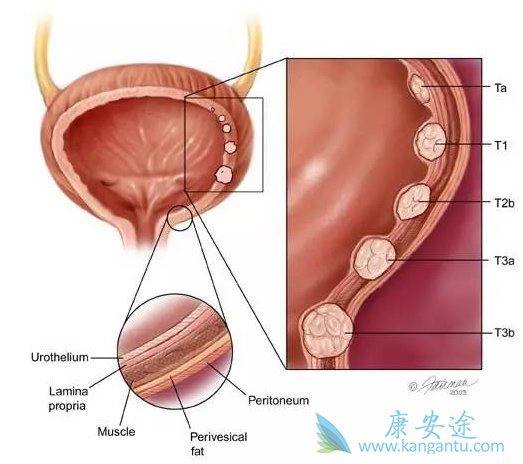 尿路上皮癌 尿路上皮癌