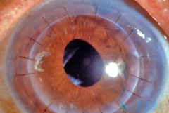 角膜移植术后如何避免感染和排斥反应？
