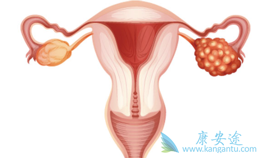 卵巢癌 卵巢癌