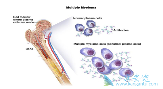 骨髓瘤 骨髓瘤