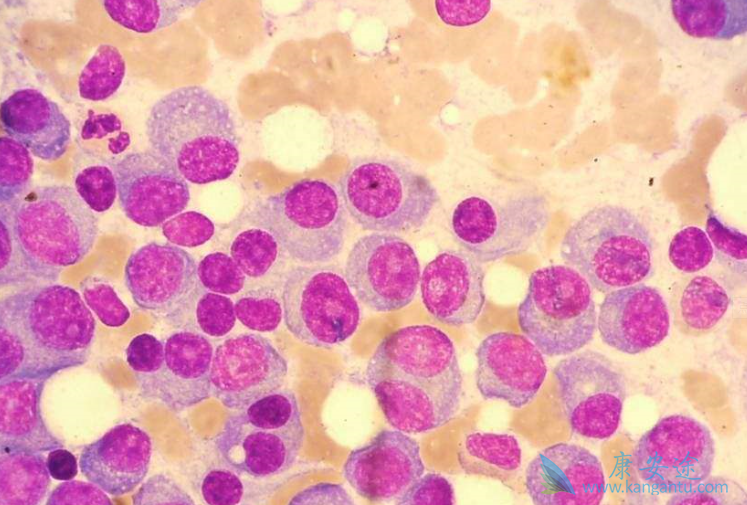 多发骨髓瘤 多发骨髓瘤